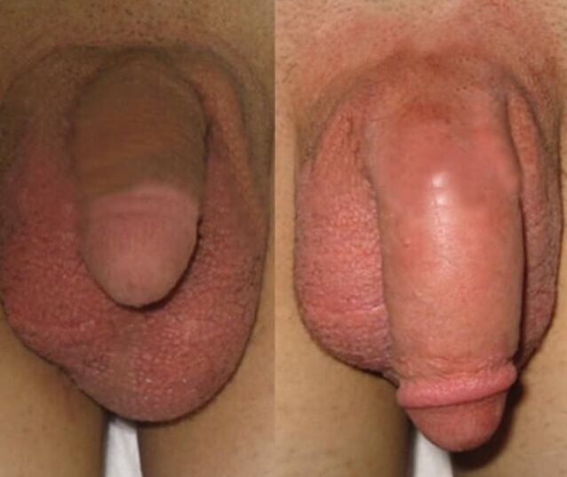 The result of installing a collagen matrix on the penis