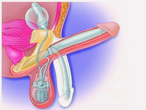 Enlargement of the penis through a penile prosthesis
