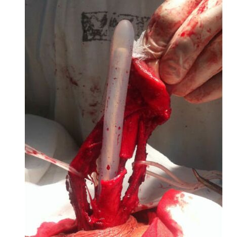 Transplantation of muscle tissue to enlarge the penis